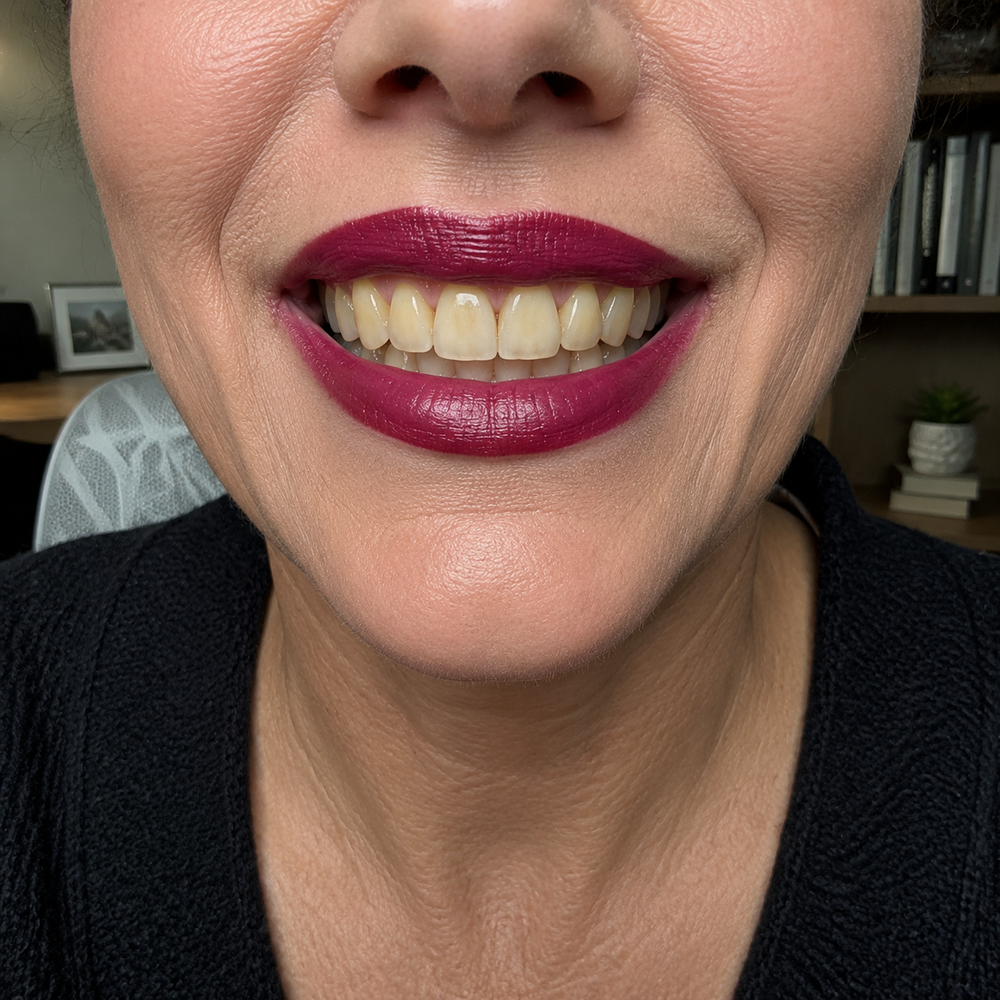 1. It Solves The Root Cause: Thinning Enamel (Not Just Stains)