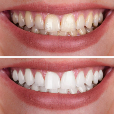 Dentley™ Purple Whitening Strips