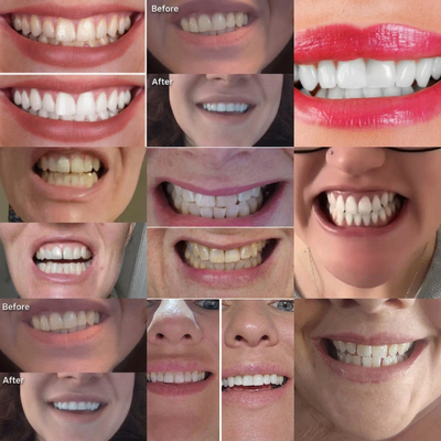 Lunira Whitening Strips