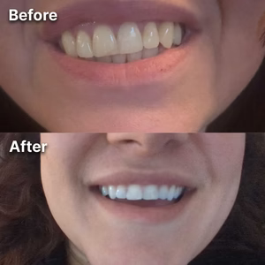 Dentley™ Purple Whitening Strips